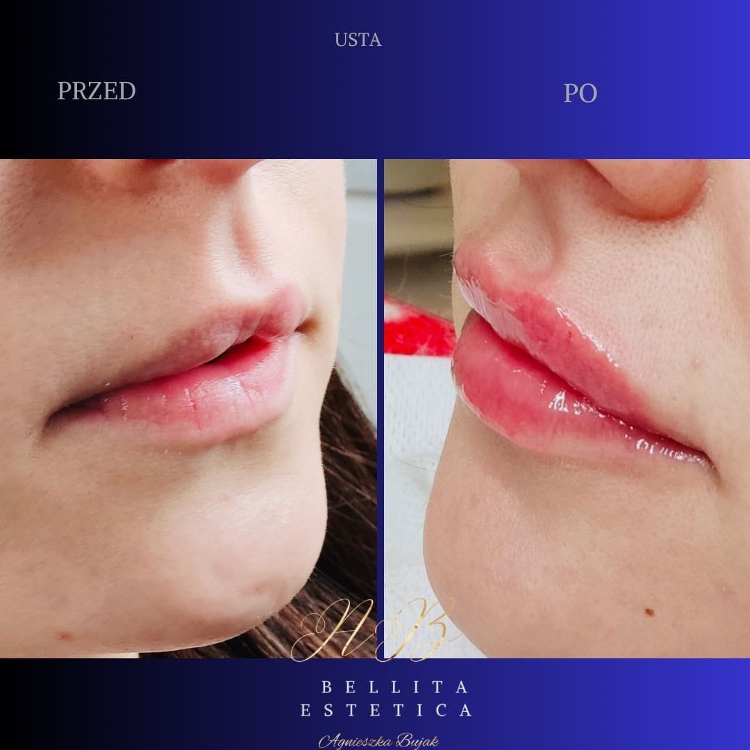 Modelowanie ust efekt